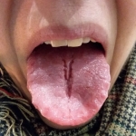 Red tongue with a center crack and teeth marks indicates heat and yin deficiency. 