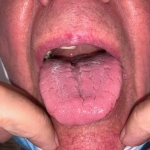 Red tongue with a center crack indicates heat and yin deficiency. 