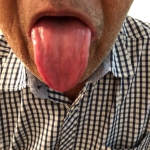 Peeled, mirror tongue indicates extreme yin deficiency. 