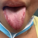 Scarlet red tongue indicates heat with red dots on the tip means fire in the heart. 